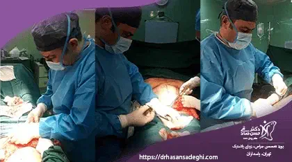 ابدومینوپلاستی-دکتر-صادقی